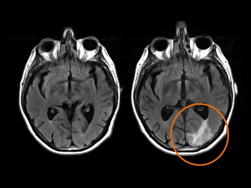ARIA-E case 27 moderate