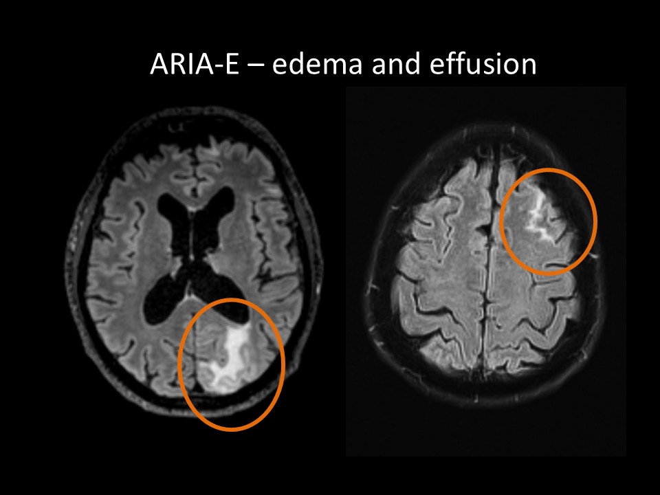 ARIA-E edema & effusion