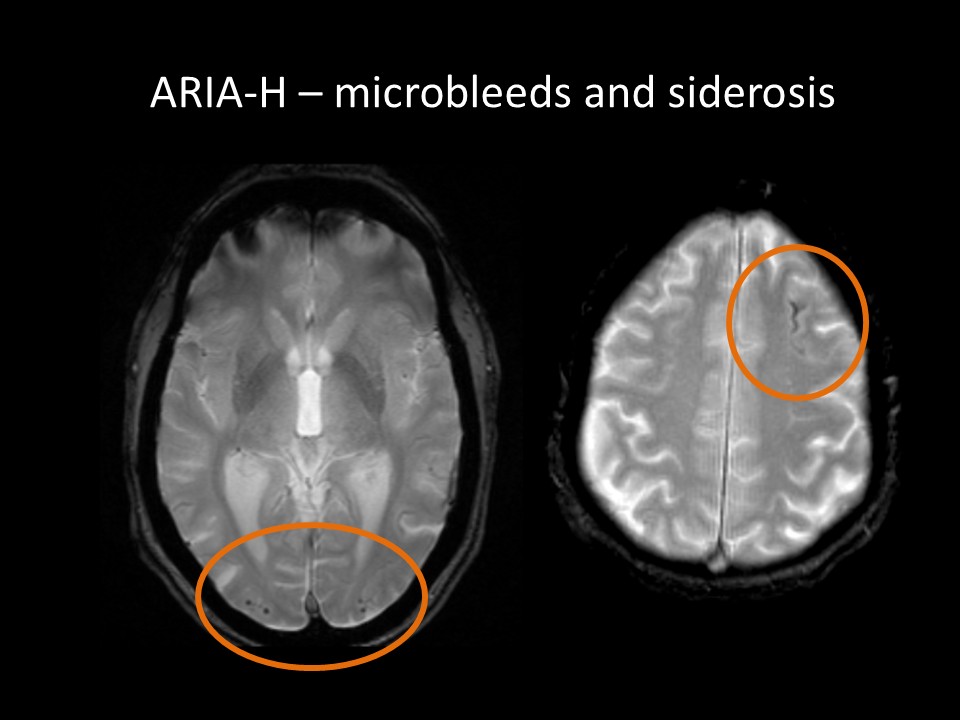 ARIA-H microbleeds and siderosis